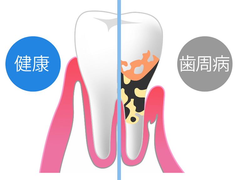 歯周病の発症原因とリスク